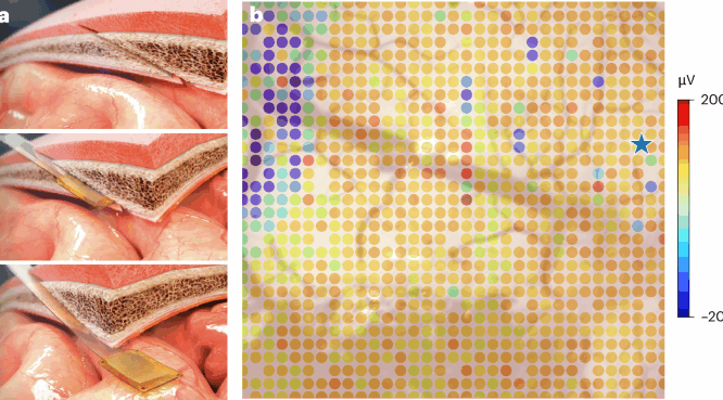 High resolution brain computer interface with electrode scalability and minimally invasive surgery nature